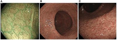 Predicting Histological Healing and Recurrence in Ulcerative Colitis by Assessing Mucosal Vascular Pattern Under Narrow-Band Imaging Endoscopy